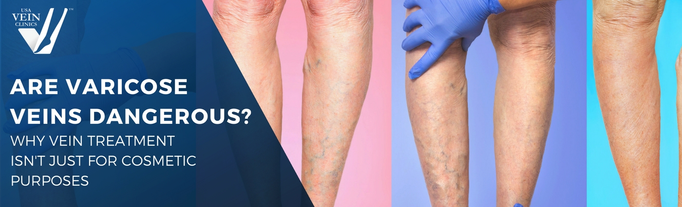 Three sets of legs with visible veins: are varicose veins dangerous?