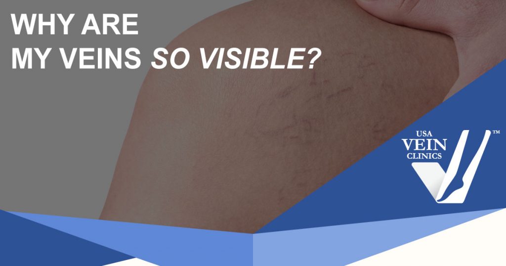 Close up of visible veins: why are veins so visible--it might be vein disease.