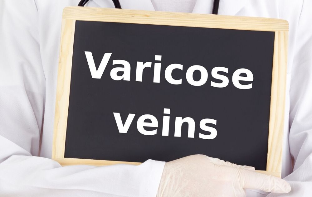 Image of a doctor holding a sign that reads "varicose veins." This image is representing how this article is a guide to understanding varicose veins.