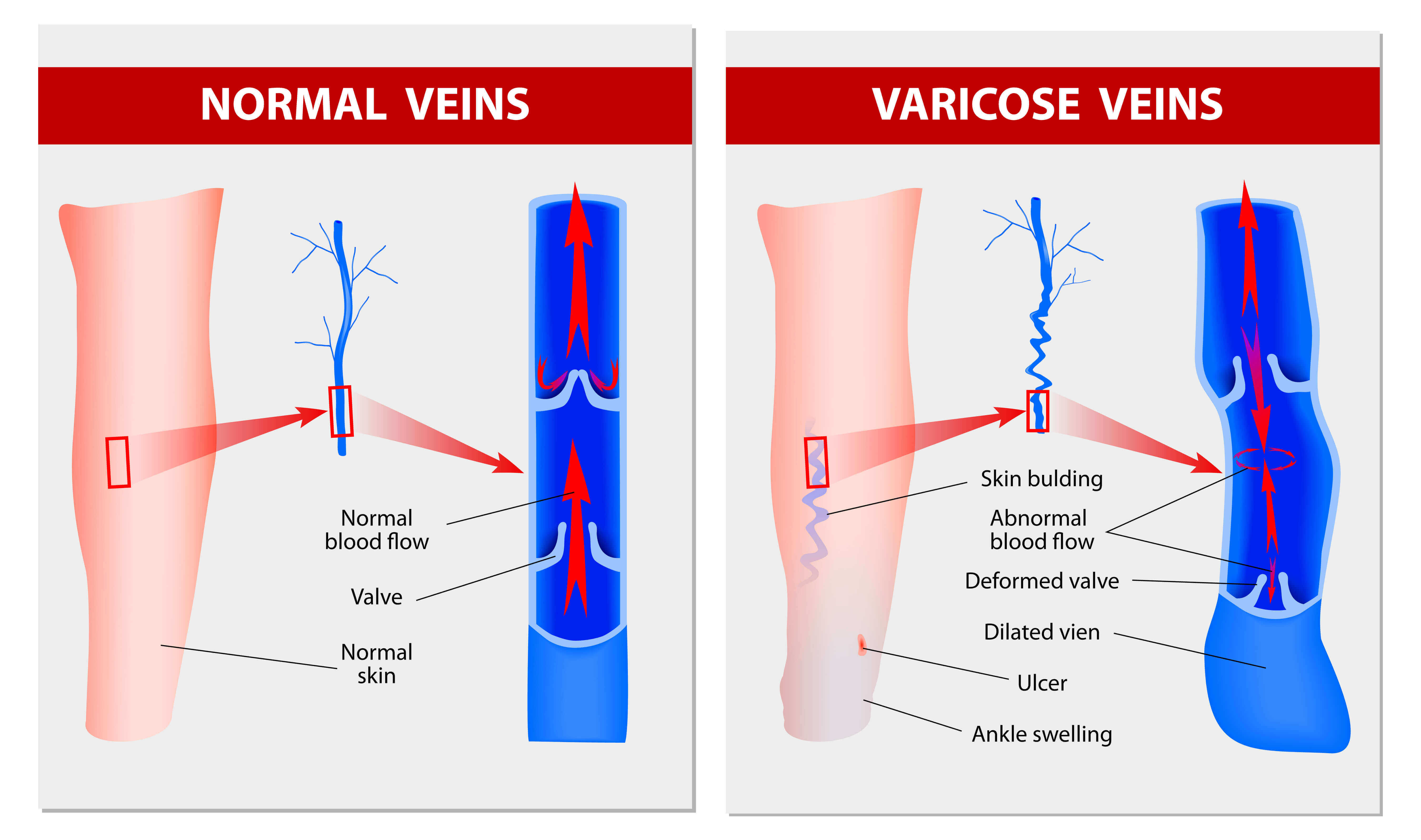 Varicose Vein Size Chart