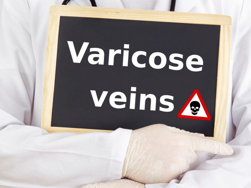 A doctor holding a chalk board with the words "varicose veins" and a danger sign.