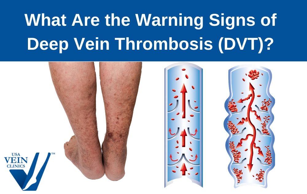 The Signs of DVT Blog Article USA Vein Clinics