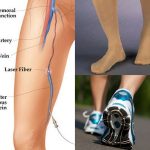 Tips for healthy legs. How to avoid varicose veins.