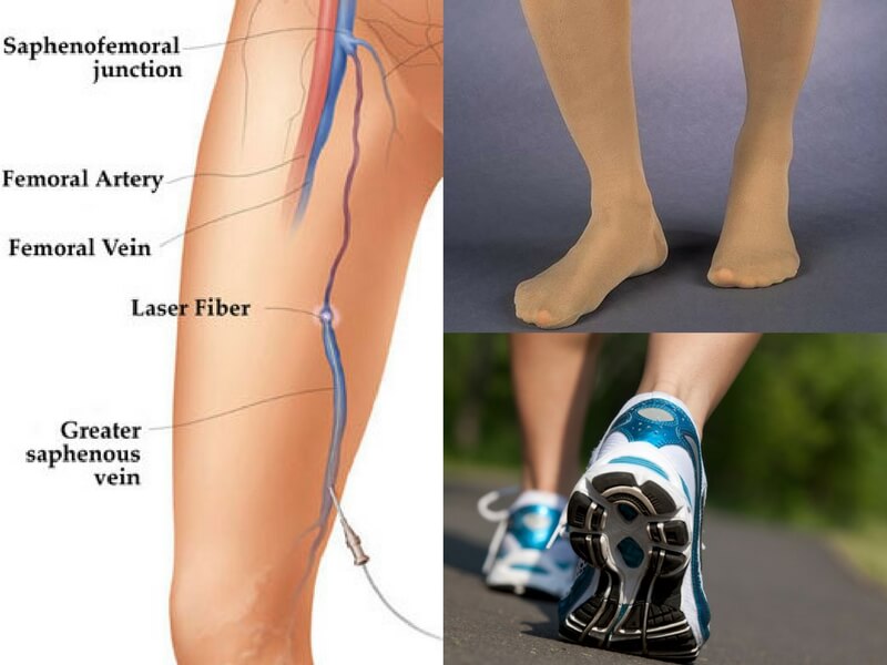 Tips for healthy legs. How to avoid varicose veins.