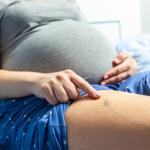 Varicose Veins During Pregnancy