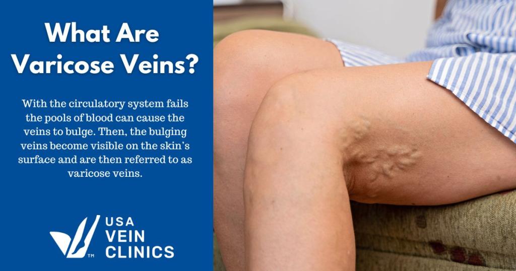 What Are Varicose Veins?