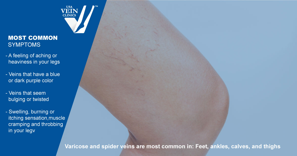 What Kind of Doctor Treats Varicose Veins?