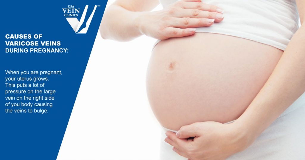 Varicose Veins During Pregnancy The Complete Guide