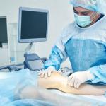 SCLEROTHERAPY VS. ENDOVENOUS LASER THERAPY