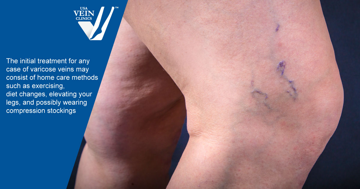 What Causes Varicose Veins In Men Usa Vein Clinics 