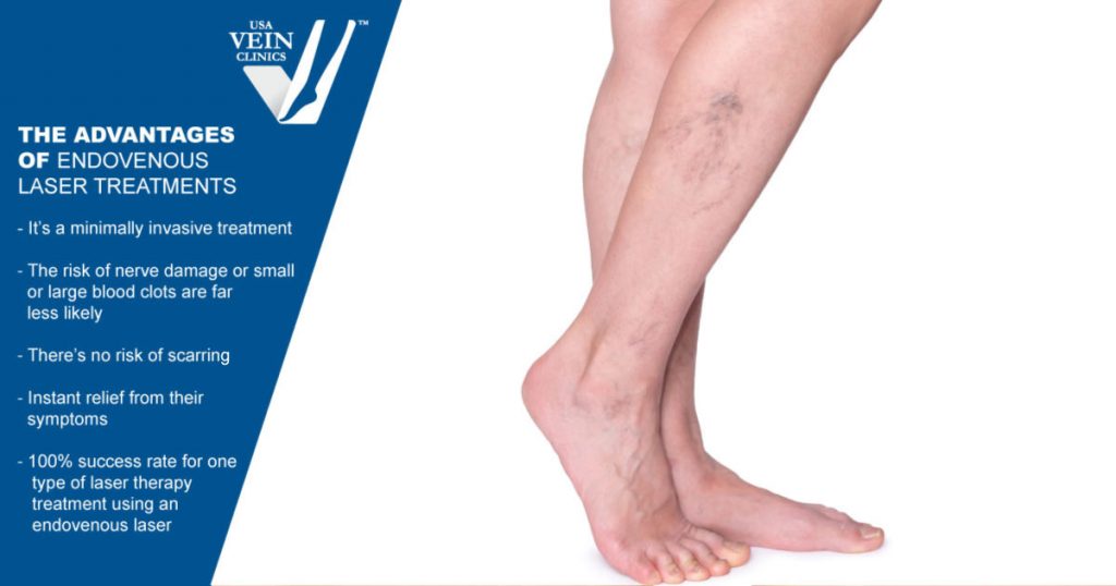 Endovenous Laser Therapy Vs. Sclerotherapy