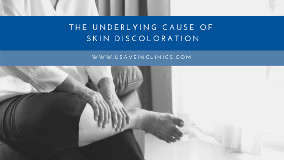 Woman sitting and holding her leg with words "the underlying cause of skin discoloration."