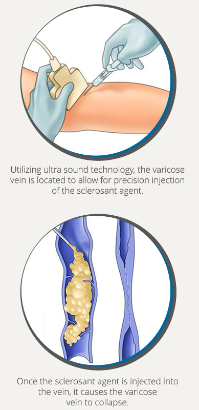 Benefits of Visual Sclerotherapy