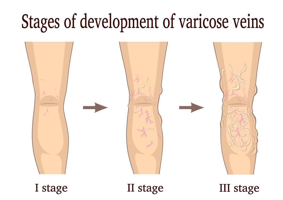 stages of development for varicose veins