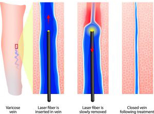 Best Treatment for Varicose Veins, Endovenous laser treatment