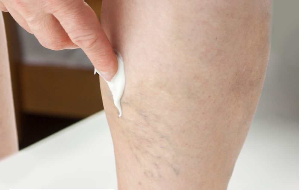 Does Varicose Vein Cream Work?