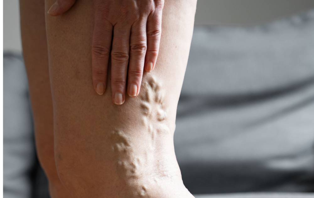 what do varicose veins feel like - what do varicose veins look like - why do varicose veins hurt