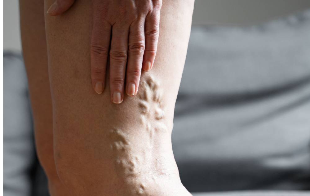 What Are Varicose Veins?