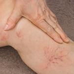 Untreated varicose veins