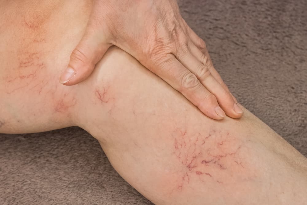 Untreated varicose veins