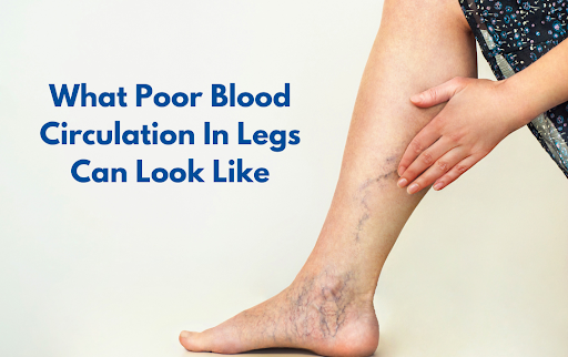 Causes of Poor Blood Circulation in Legs