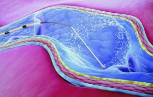 Clarivein® Treatment For Varicose Veins 5 clarivein vein treatment