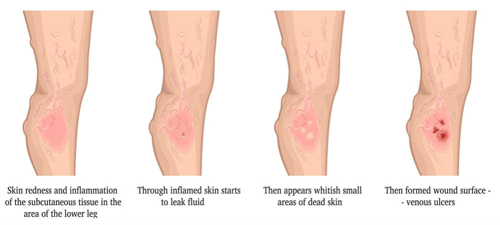 Venous leg ulcer stages
