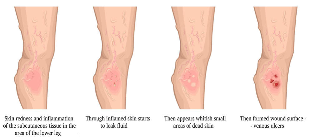 Venous Insufficiency Can Be Debilitating and Deadly If Untreated