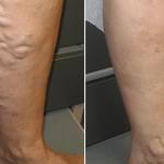 varicose veins on the legs