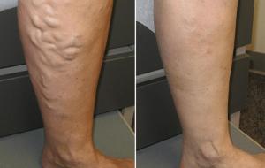 Before And After 9 varicose veins on the legs