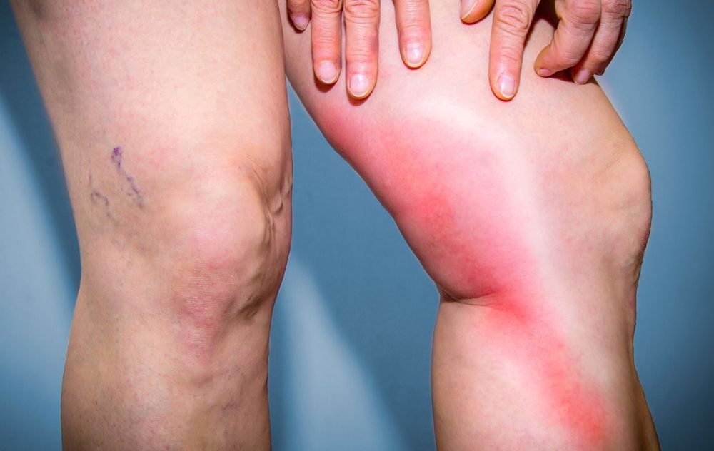 what is phlebitis - how does it differ from deep vein thrombosis