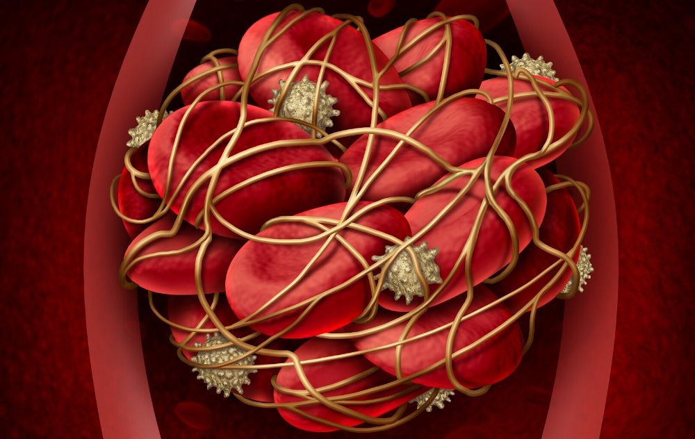 blood clot in blood vessel