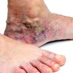 skin discoloration from vein disease