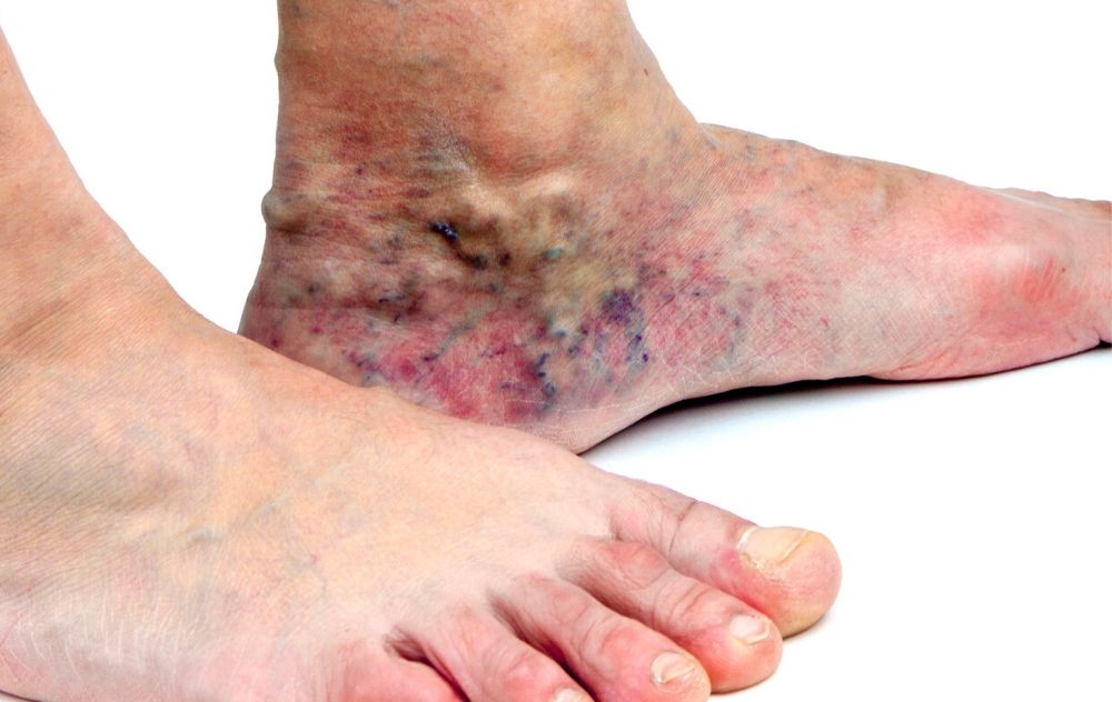 skin discoloration from vein disease