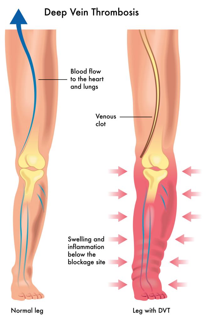 Deep Vein Thrombosis Symptoms