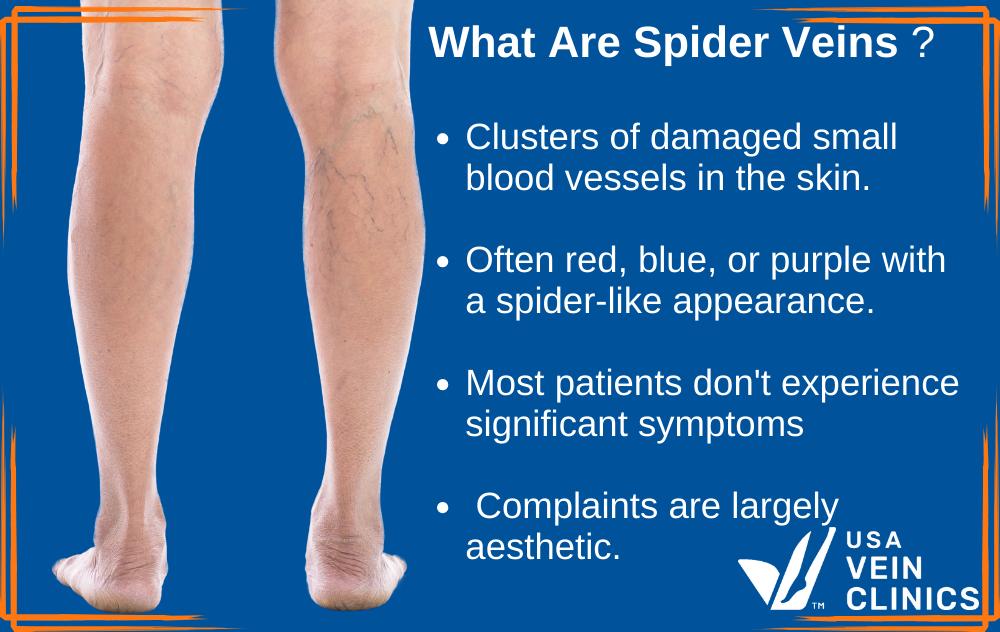 Do Spider Veins Hurt