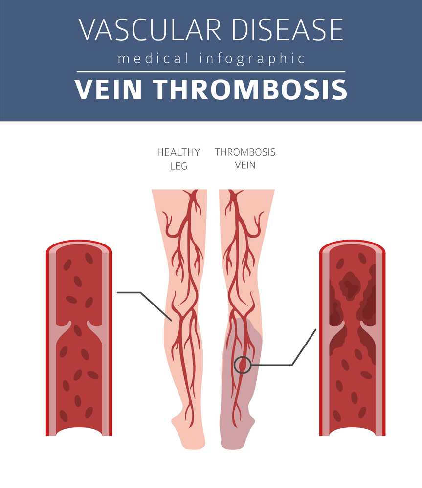 Deep Vein Thrombosis vs Normal Veins