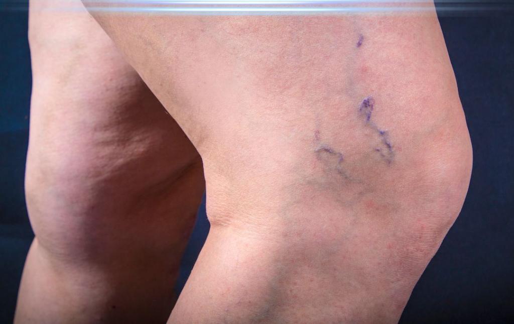 Spider Vein Facts