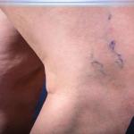 Spider Vein Facts