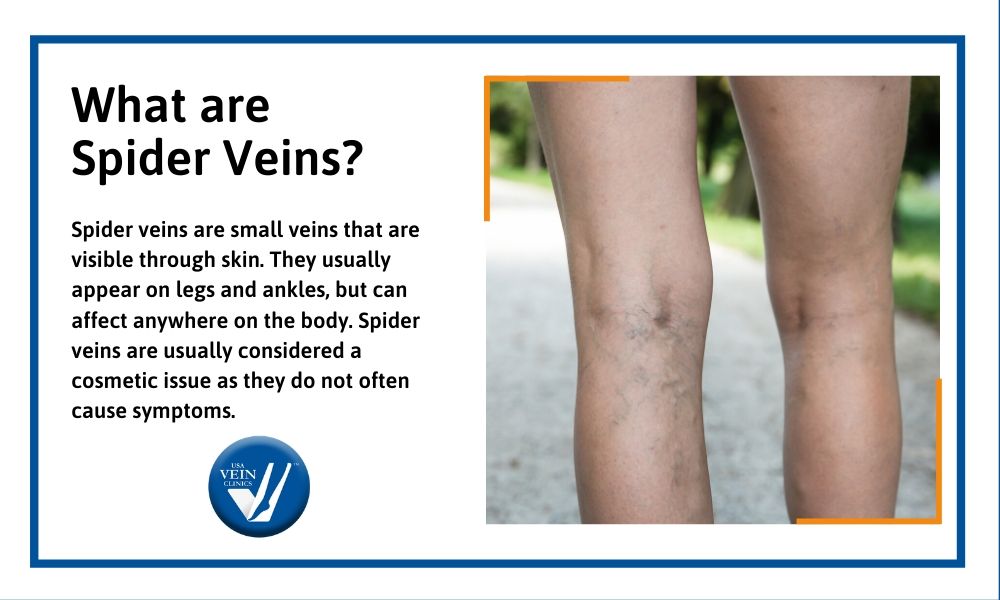 What are spider veins