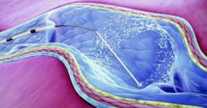 clarivein treatment inside the vein diagram