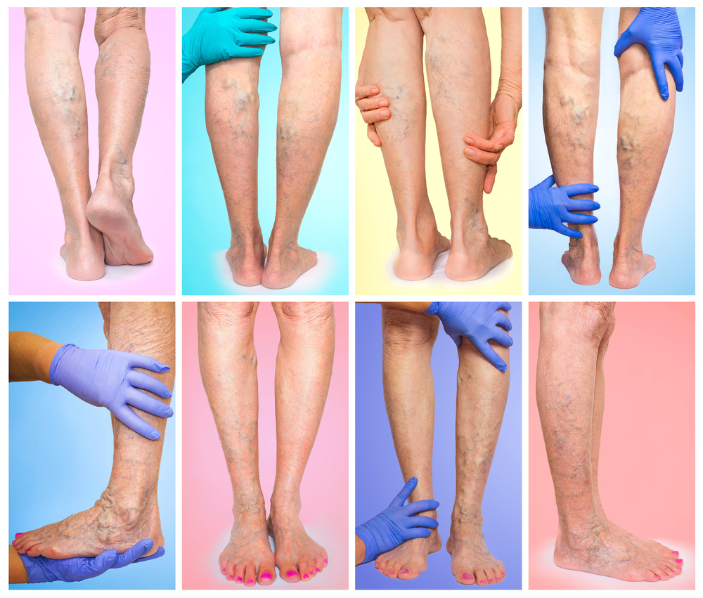 Varicose Vein Treatment and Procedures | USA Vein Clinics