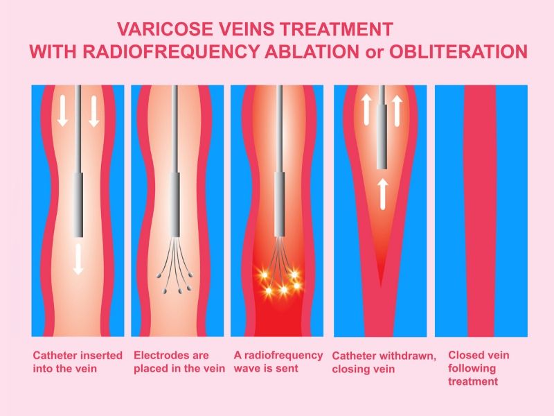 Varicose Vein Surgery
