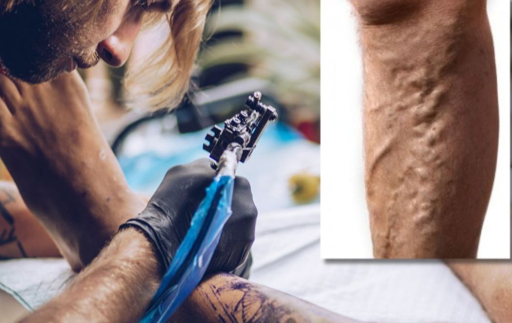 can you tattoo over varicose veins
