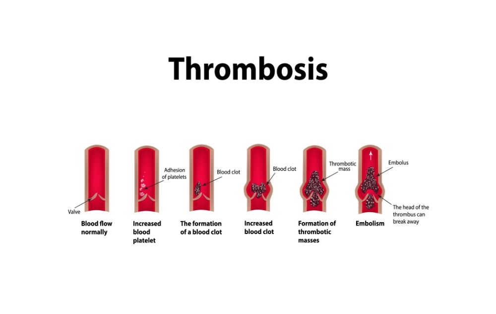 thrombosis - what does a blood clot in the leg feel like