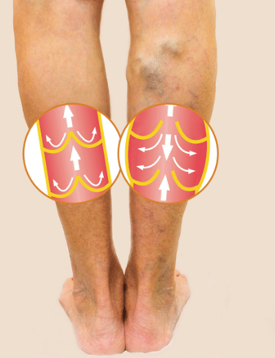 Varices en las piernas - Tratamientos percutáneos