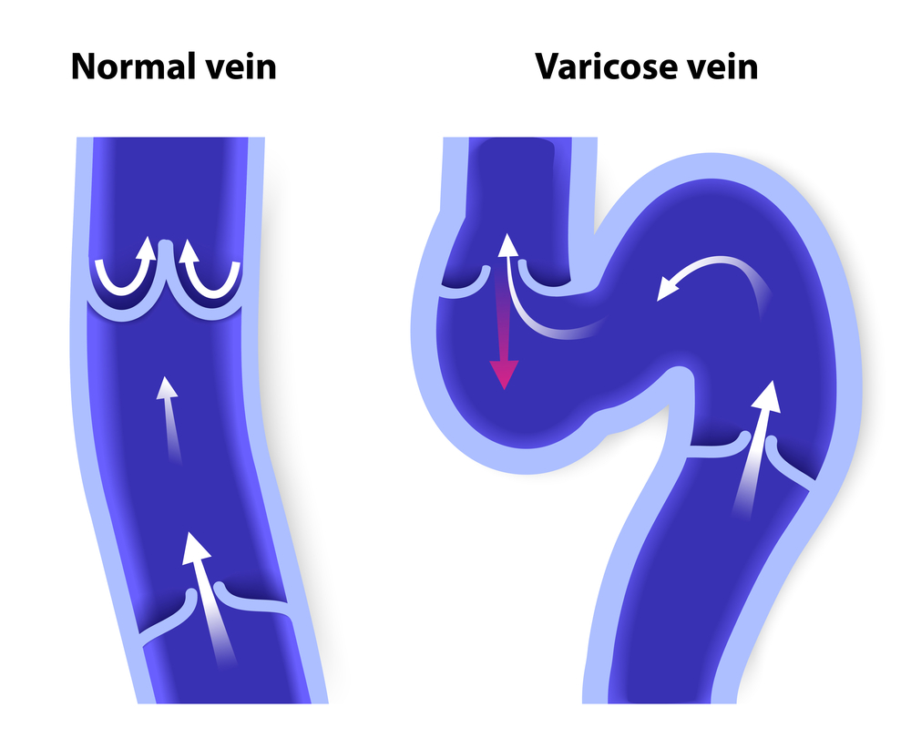 This Underdiagnosed Vein Issue Could Be Holding You Back Learn More - wd6byzc