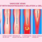 is vein ablation painful