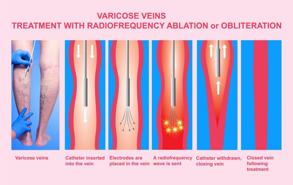 is vein ablation painful