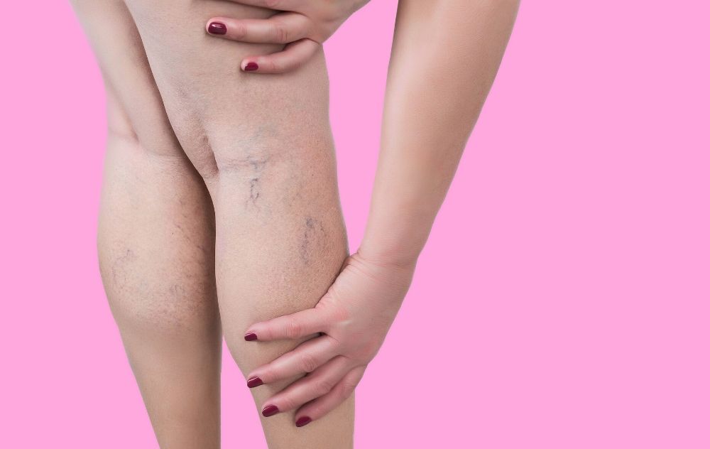 do spider veins hurt